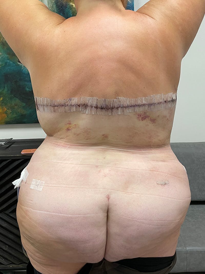 Plus Size Tummy Tuck: Week After Surgery Before & After Gallery - Patient 330083 - Image 4