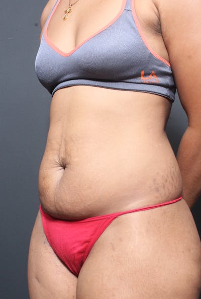 Tummy Tuck Before & After Gallery - Patient 358229 - Image 1