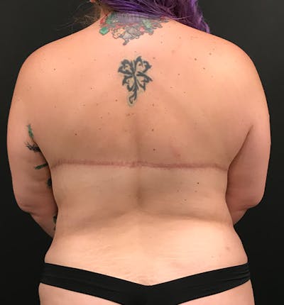Bra Line Back Lift ™ Before & After Gallery - Patient 124351 - Image 2