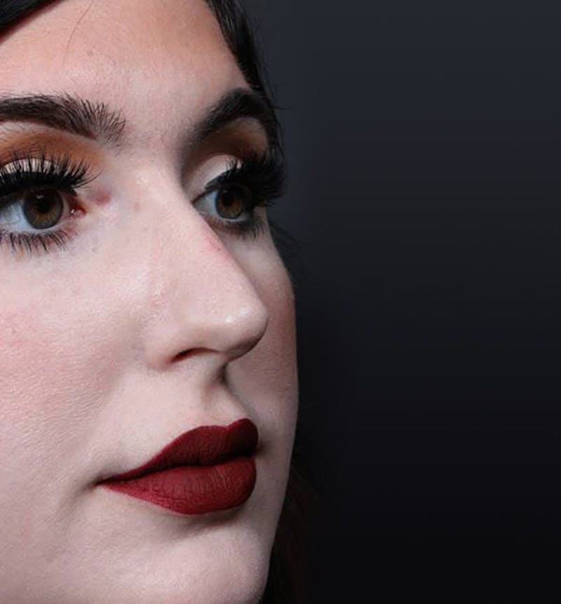 Rhinoplasty Before & After Gallery - Patient 143669 - Image 5