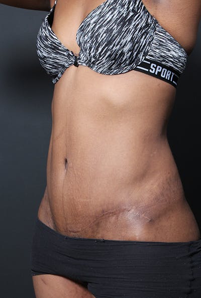 Tummy Tuck Before & After Gallery - Patient 358229 - Image 2