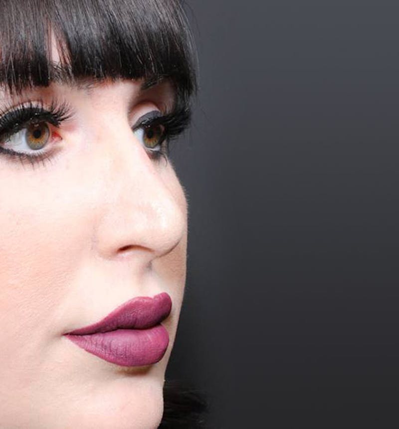 Rhinoplasty Before & After Gallery - Patient 143669 - Image 6