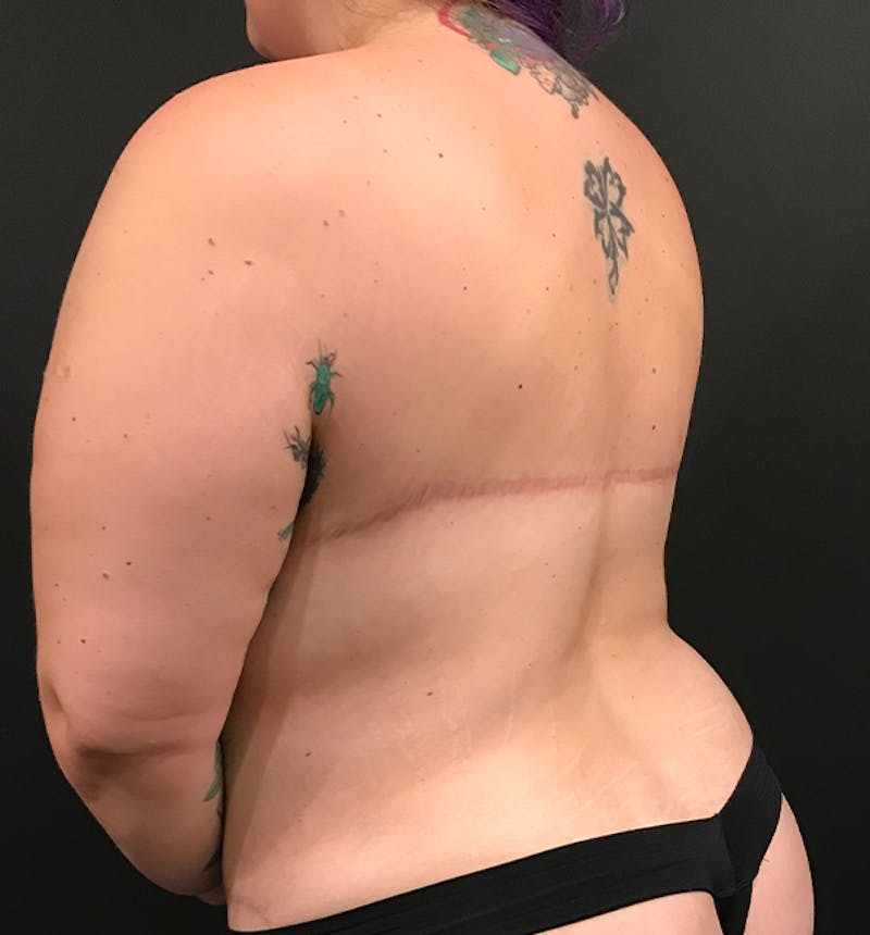 Bra Line Back Lift ™ Before & After Gallery - Patient 124351 - Image 4