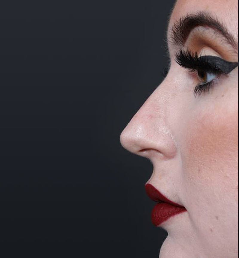 Rhinoplasty Before & After Gallery - Patient 143669 - Image 7