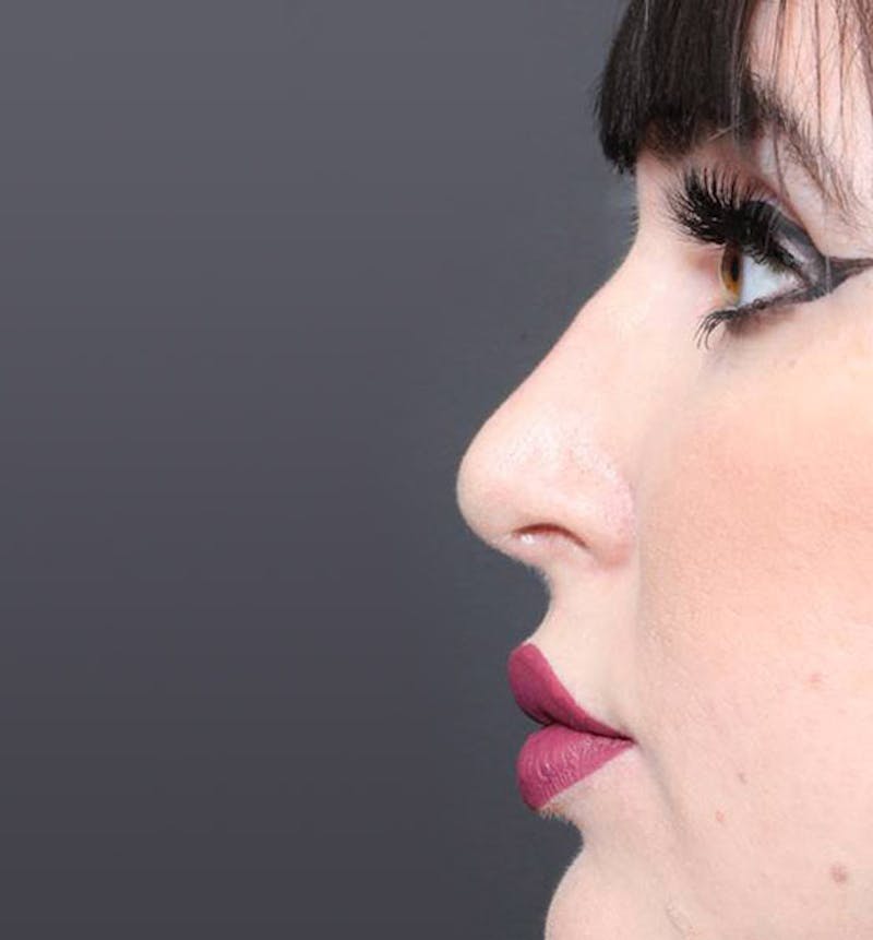 Rhinoplasty Before & After Gallery - Patient 143669 - Image 8