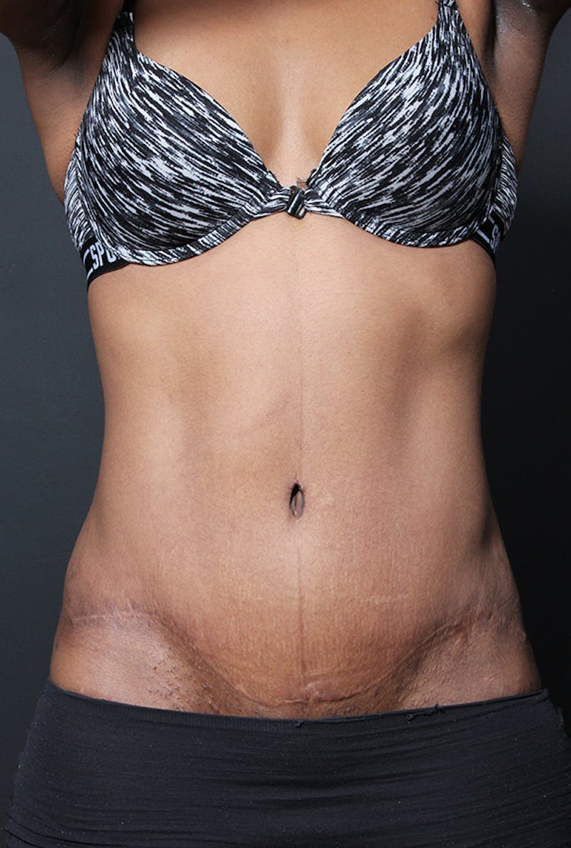 Tummy Tuck Before & After Gallery - Patient 358229 - Image 4