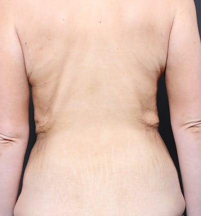 Bra Line Back Lift ™ Before & After Gallery - Patient 261798 - Image 1