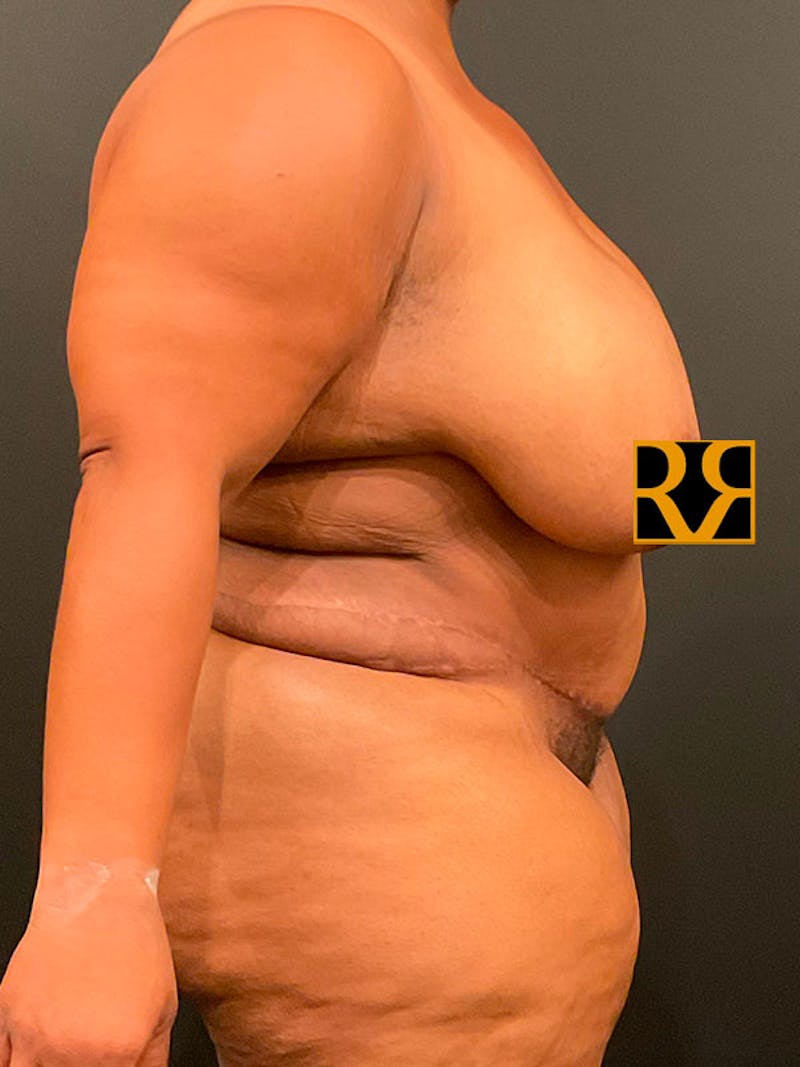 Plus Size Tummy Tuck ® Before & After Gallery - Patient 323160 - Image 4