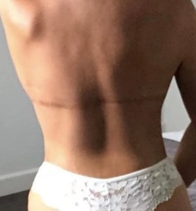 Bra Line Back Lift ™ Before & After Gallery - Patient 261798 - Image 2