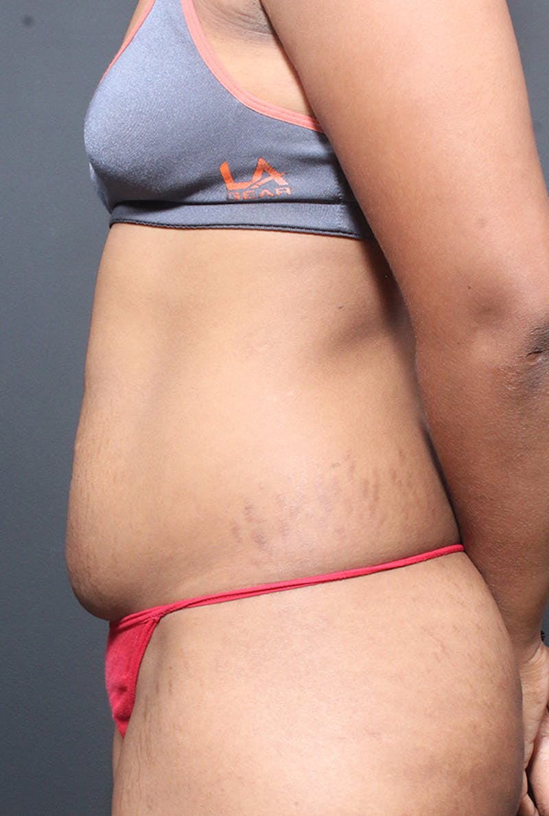 Tummy Tuck Before & After Gallery - Patient 358229 - Image 5