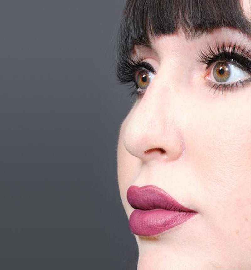 Rhinoplasty Before & After Gallery - Patient 143669 - Image 10