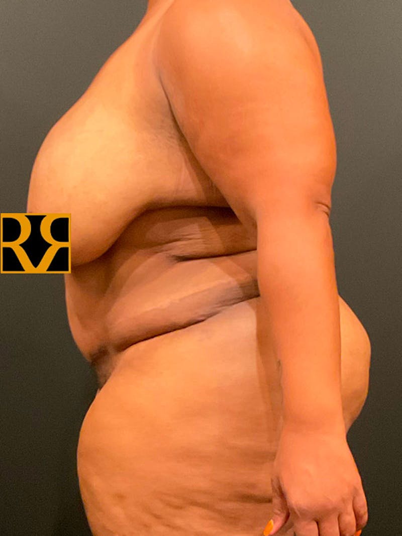 Plus Size Tummy Tuck ® Before & After Gallery - Patient 323160 - Image 6