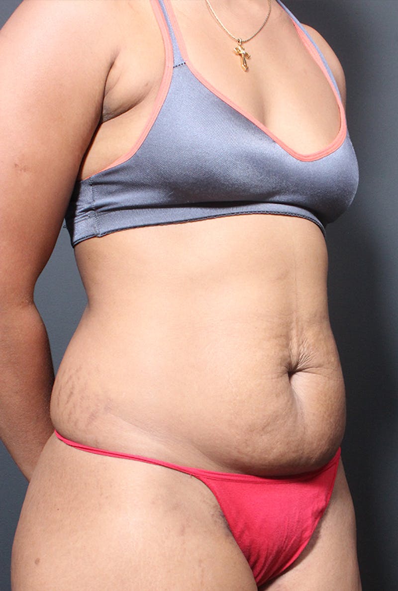 Tummy Tuck Before & After Gallery - Patient 358229 - Image 7