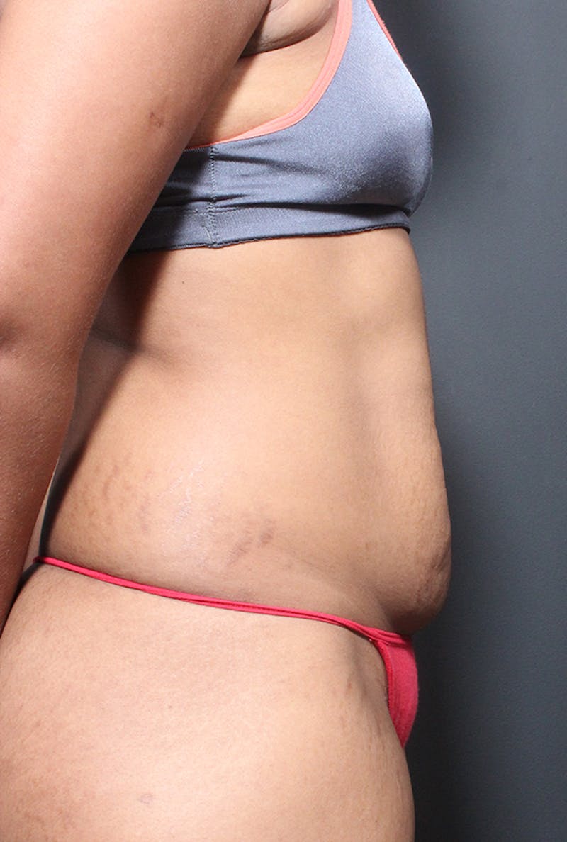 Tummy Tuck Before & After Gallery - Patient 358229 - Image 9