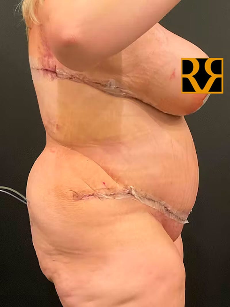 Plus Size Tummy Tuck ® Before & After Gallery - Patient 209503 - Image 4