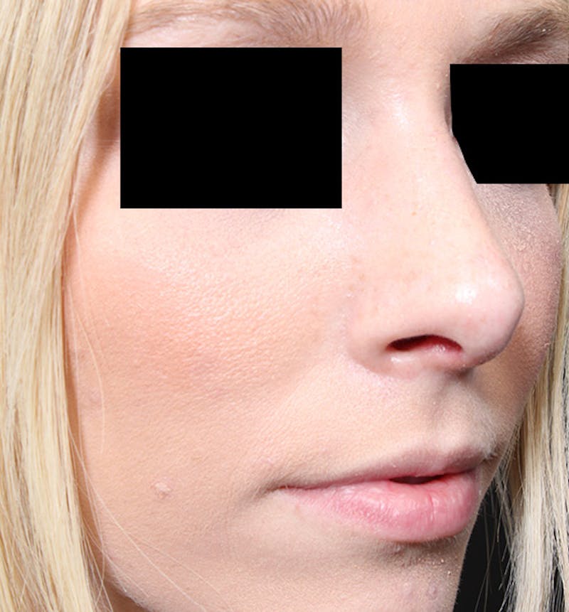 Rhinoplasty Before & After Gallery - Patient 159388 - Image 8