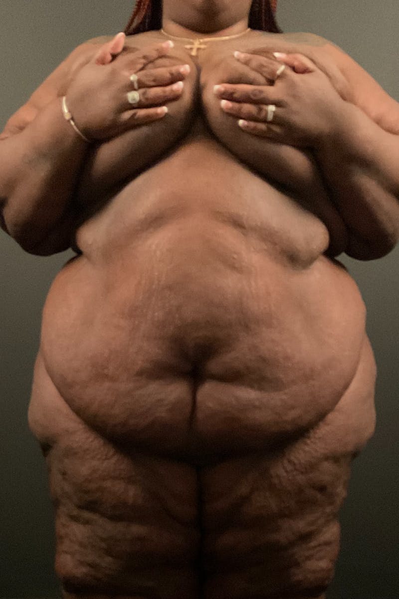 Plus Size Tummy Tuck: Week After Surgery Before & After Gallery - Patient 477122 - Image 1