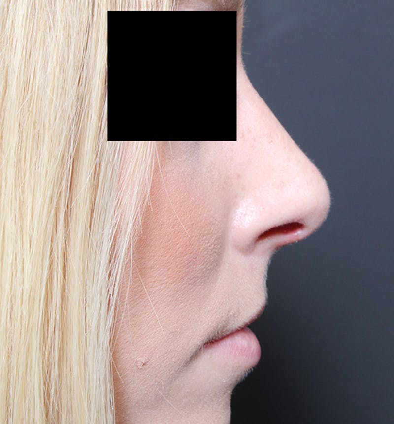 Rhinoplasty Before & After Gallery - Patient 159388 - Image 10