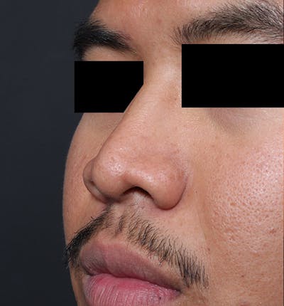 Rhinoplasty Before & After Gallery - Patient 254455 - Image 1