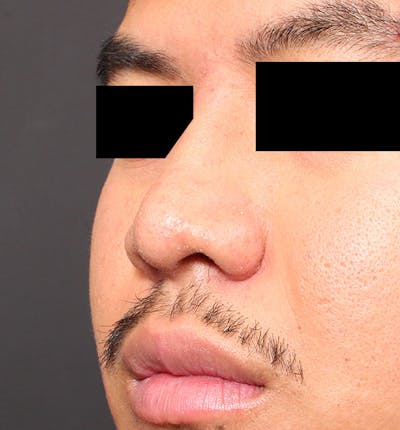 Rhinoplasty Before & After Gallery - Patient 254455 - Image 2