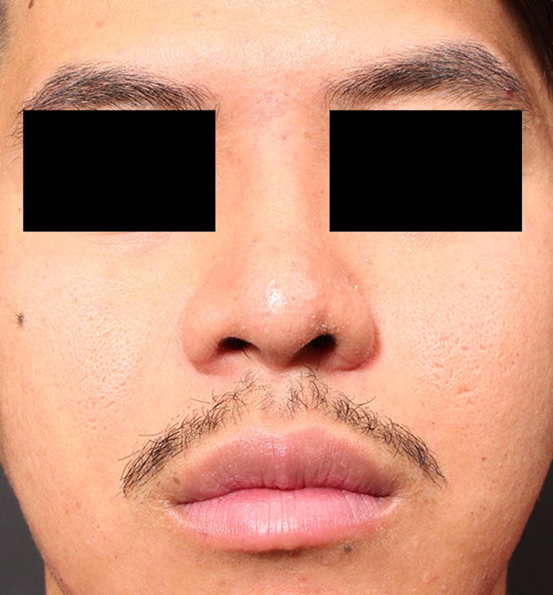 Rhinoplasty Before & After Gallery - Patient 254455 - Image 4