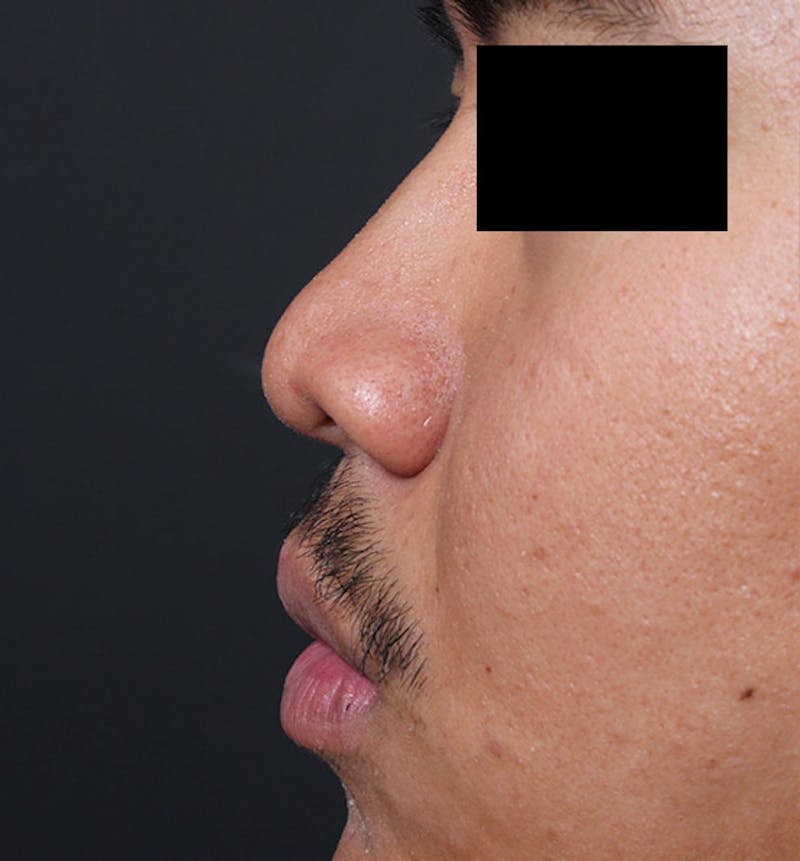 Rhinoplasty Before & After Gallery - Patient 254455 - Image 5