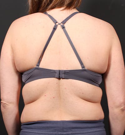 Bra Line Back Lift ™ Before & After Gallery - Patient 245544 - Image 1