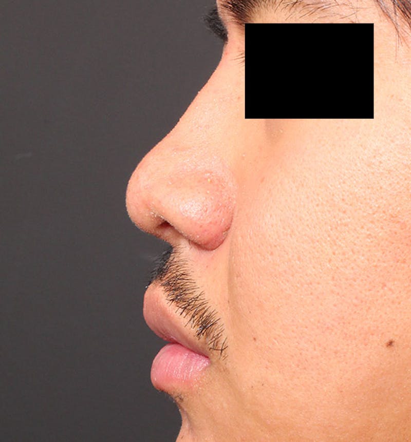 Rhinoplasty Before & After Gallery - Patient 254455 - Image 6