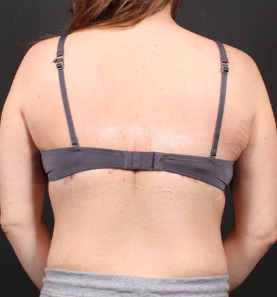 Bra Line Back Lift ™ Before & After Gallery - Patient 245544 - Image 2