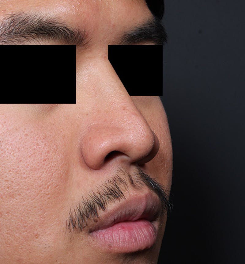 Rhinoplasty Before & After Gallery - Patient 254455 - Image 7