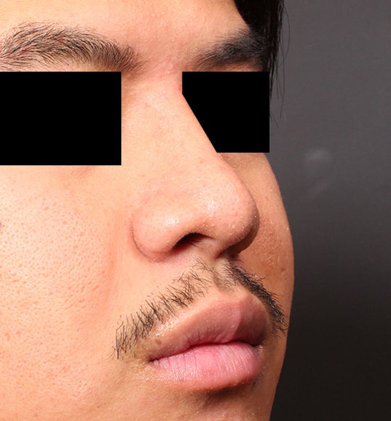 Rhinoplasty Before & After Gallery - Patient 254455 - Image 8