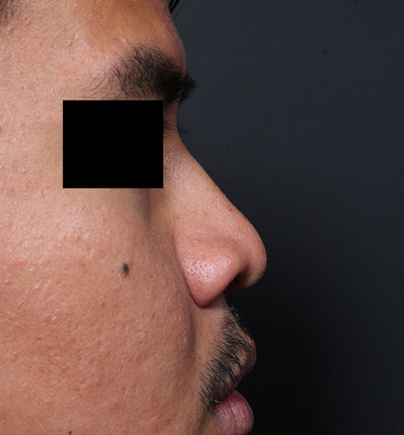 Rhinoplasty Before & After Gallery - Patient 254455 - Image 9