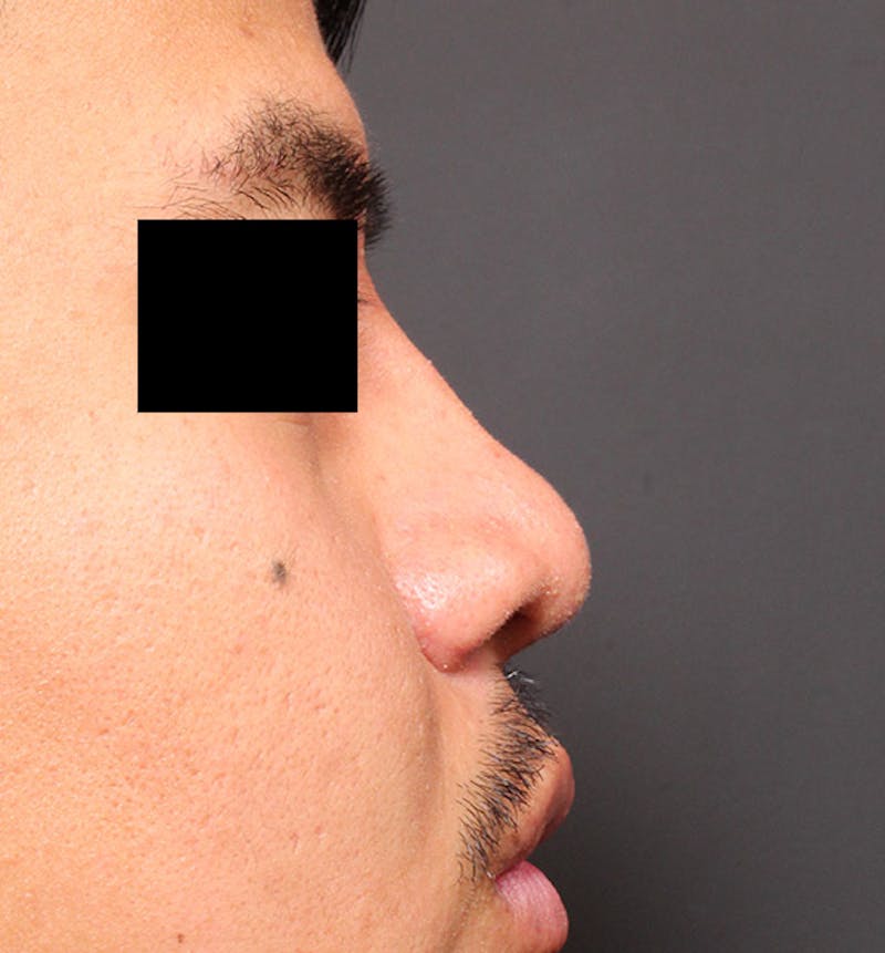 Rhinoplasty Before & After Gallery - Patient 254455 - Image 10