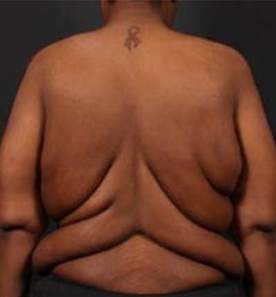 Bra Line Back Lift ™ Before & After Gallery - Patient 591296 - Image 1