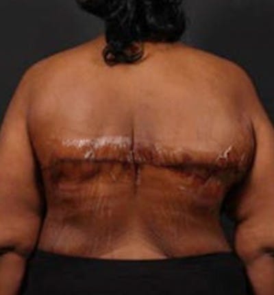 Bra Line Back Lift ™ Before & After Gallery - Patient 591296 - Image 2