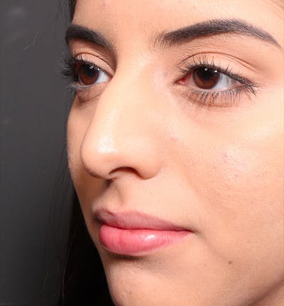 Rhinoplasty Before & After Gallery - Patient 203537 - Image 1
