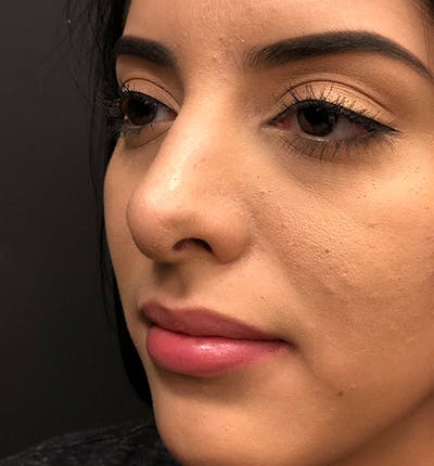 Rhinoplasty Before & After Gallery - Patient 203537 - Image 2
