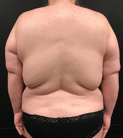 Bra Line Back Lift ™ Before & After Gallery - Patient 620918 - Image 1