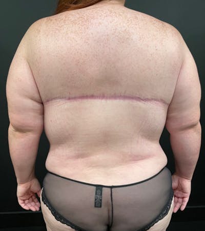 Bra Line Back Lift ™ Before & After Gallery - Patient 620918 - Image 2