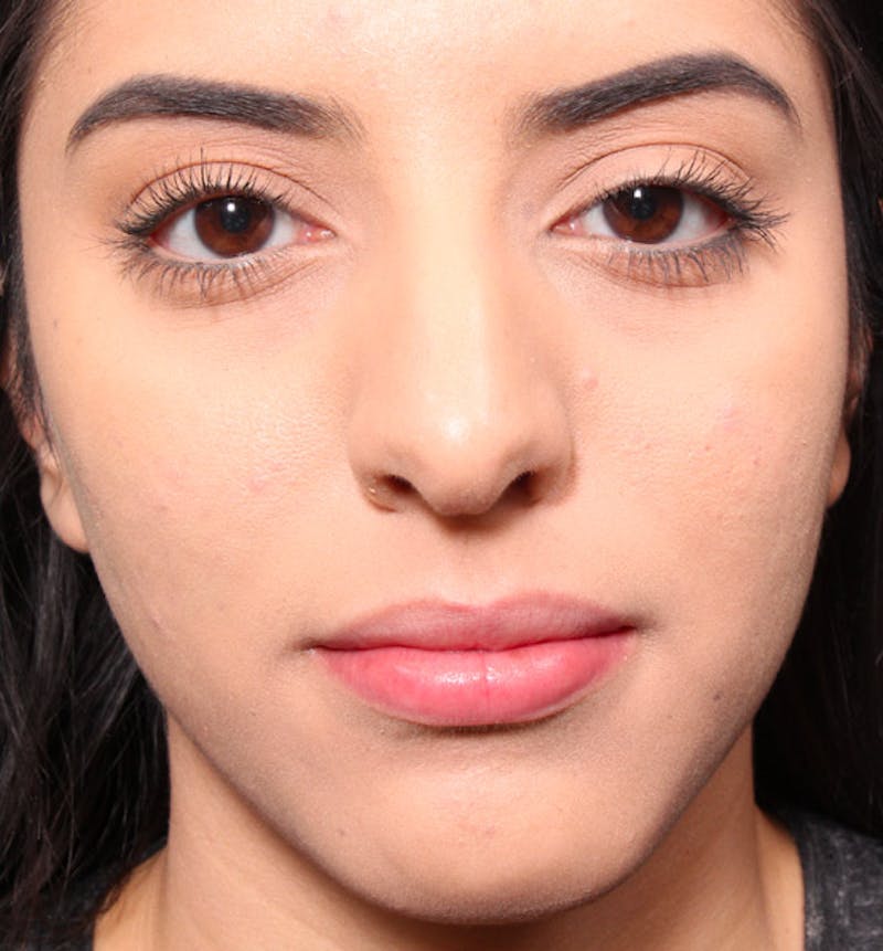 Rhinoplasty Before & After Gallery - Patient 203537 - Image 3