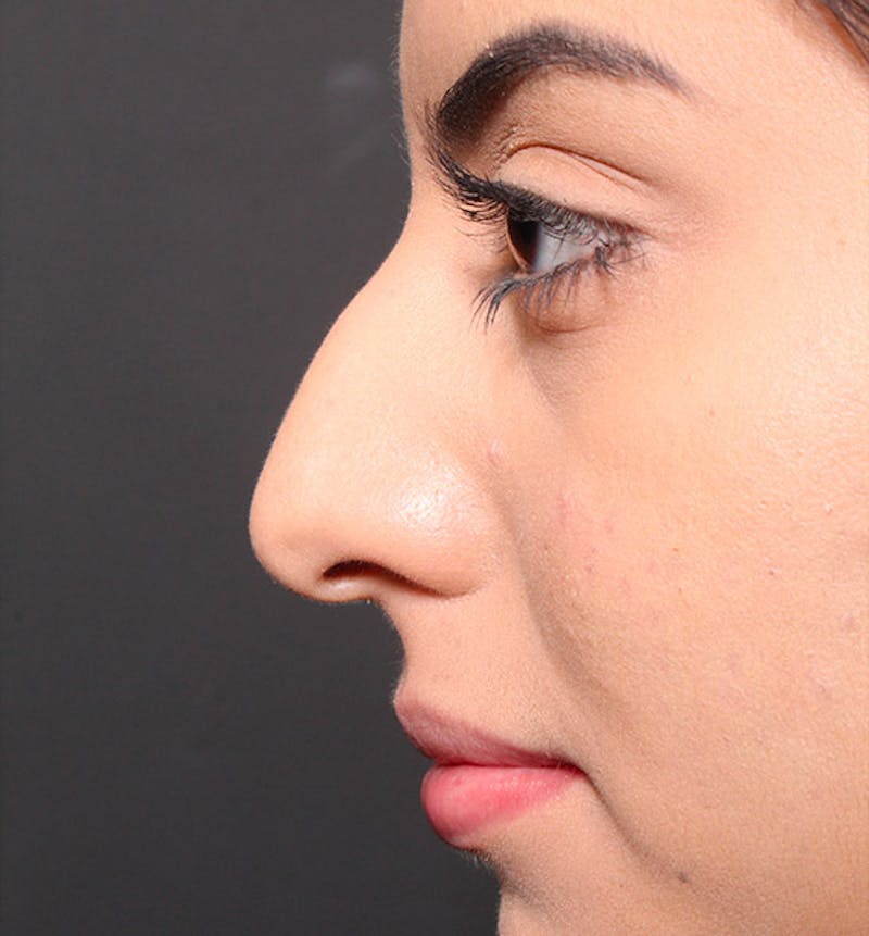 Rhinoplasty Before & After Gallery - Patient 203537 - Image 5