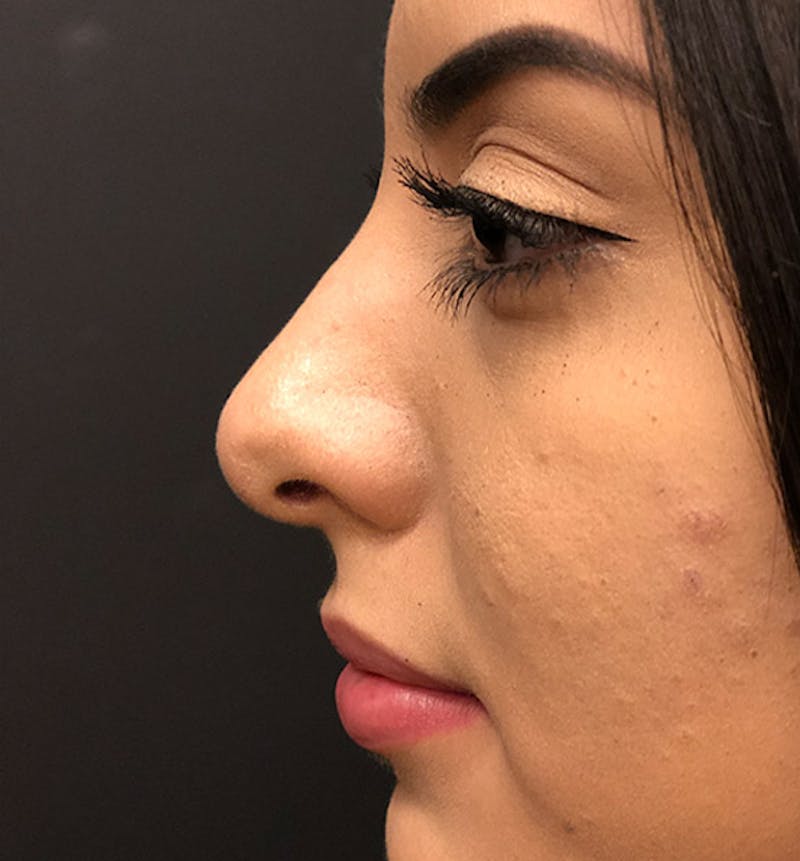 Rhinoplasty Before & After Gallery - Patient 203537 - Image 6