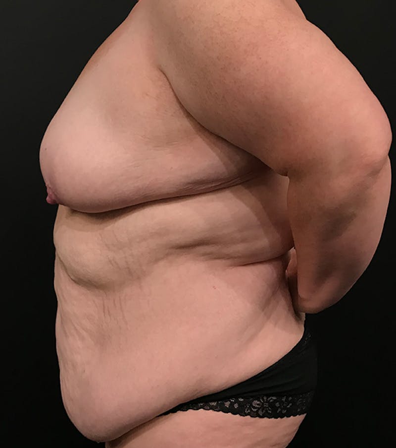 Bra Line Back Lift ™ Before & After Gallery - Patient 620918 - Image 5