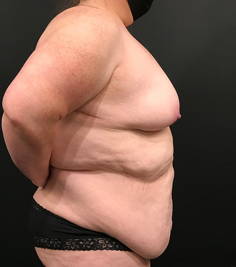 Bra Line Back Lift ™ Before & After Gallery - Patient 620918 - Image 9