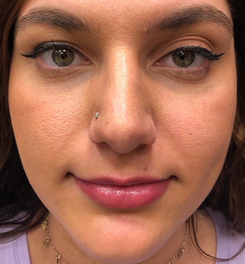 Rhinoplasty Before & After Gallery - Patient 175577 - Image 4