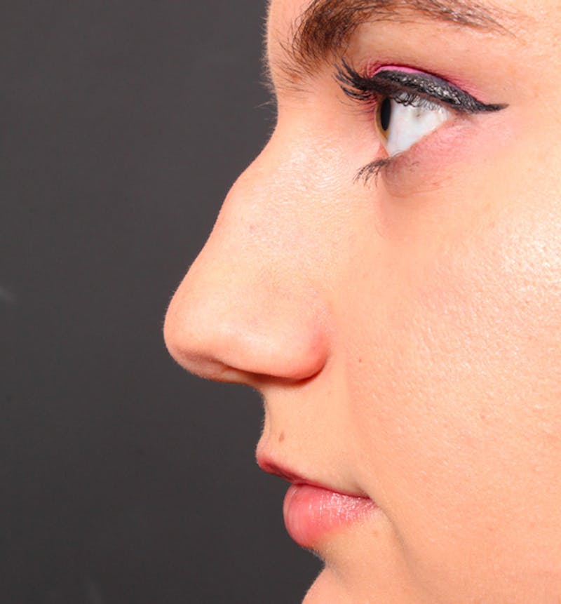 Rhinoplasty Before & After Gallery - Patient 175577 - Image 5