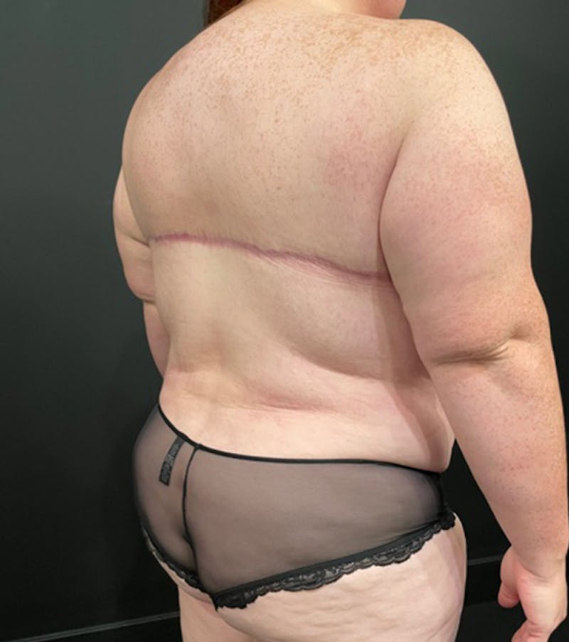 Bra Line Back Lift ™ Before & After Gallery - Patient 620918 - Image 12