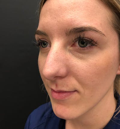 Rhinoplasty Before & After Gallery - Patient 417796 - Image 1