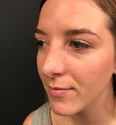 Rhinoplasty Before & After Gallery - Patient 417796 - Image 2