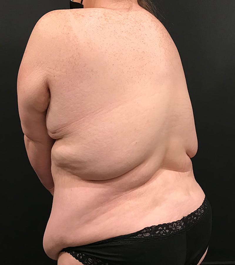 Bra Line Back Lift ™ Before & After Gallery - Patient 620918 - Image 13